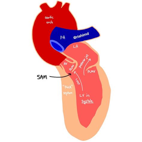 lv pressure trace|Left ventricular outflow tract obstruction .